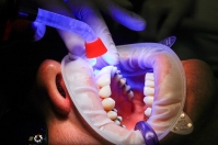 Jak wygląda wybielanie zębów u stomatologa?