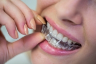 Ortodoncja dla dorosłych: Wykorzystanie niewidocznych aparatów ortodontycznych.