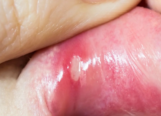 Dlaczego niektóre afty goją się szybciej niż inne?