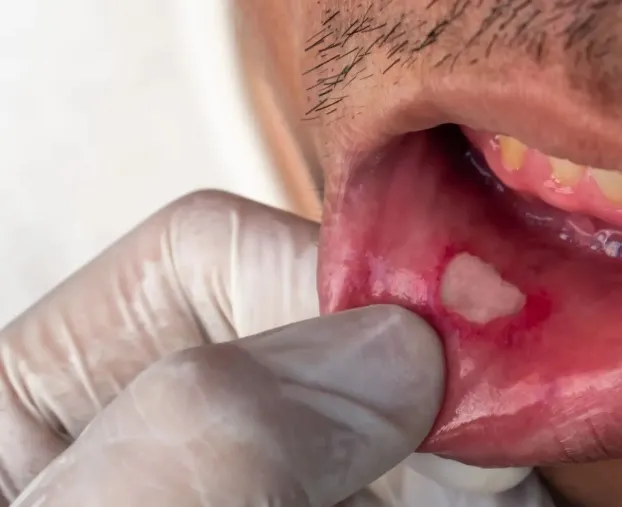 Czy ten sam żel na afty działa na wszystkie typy zmian?