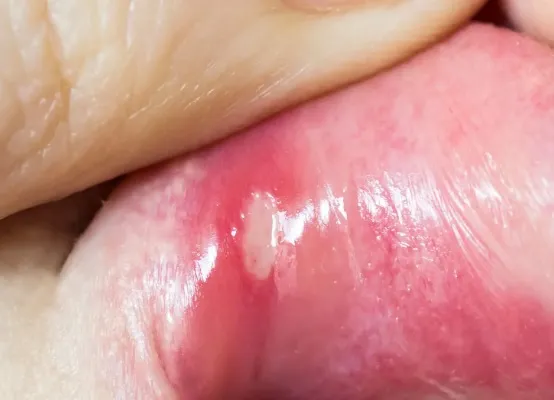 Czy nawracające afty wymagają innego leczenia niż pojedyncze zmiany?