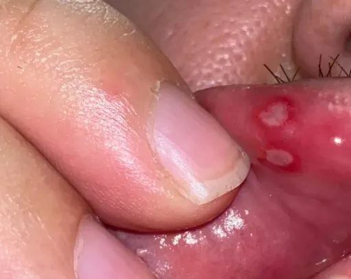 Czy czas trwania objawów zależy od rodzaju afty?